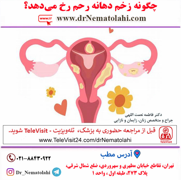 چگونه زخم دهانه رحم رخ می‌دهد؟