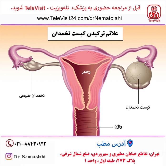 کیست تخمدان و انواع آن