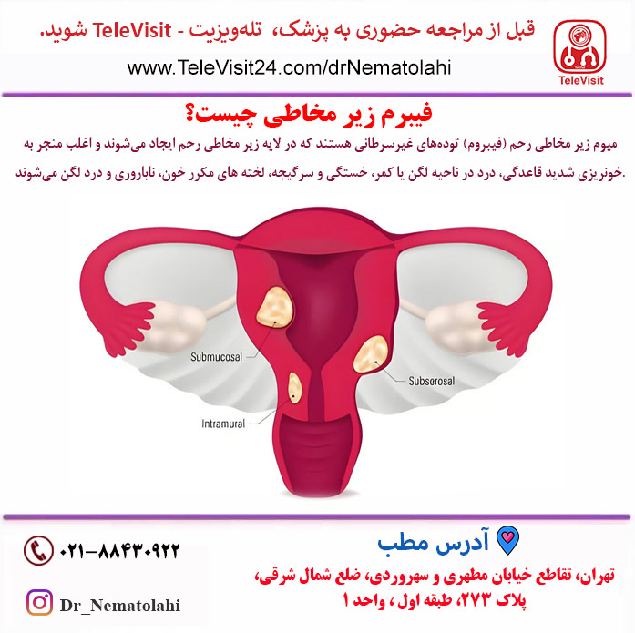 فیبرم ساب موکوزال رحمی